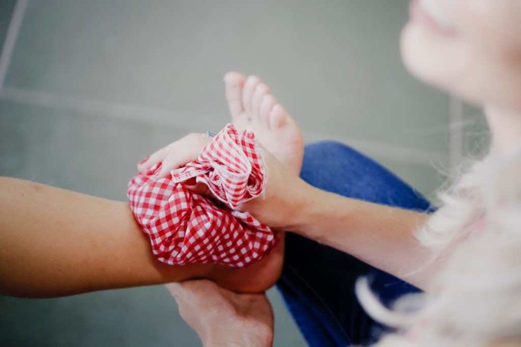 Hypermobile foot with ice