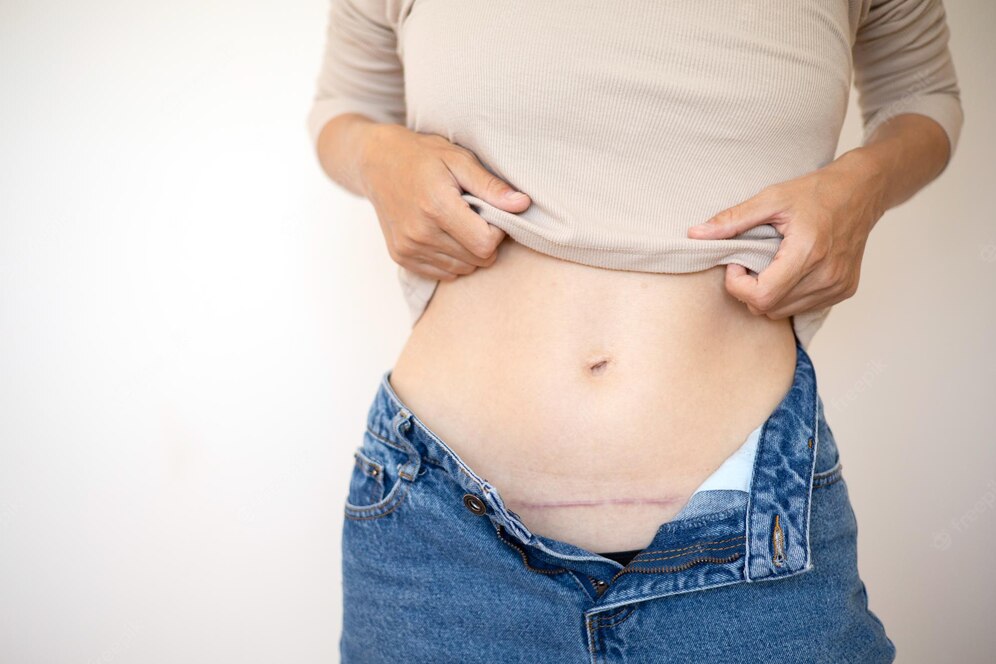 close-up-mom39s-abdomen-after-cesarean-section-scar-seam-bodypositive-diversity-real-motherhood-lifestyle_444187-1116 cesarean section scar