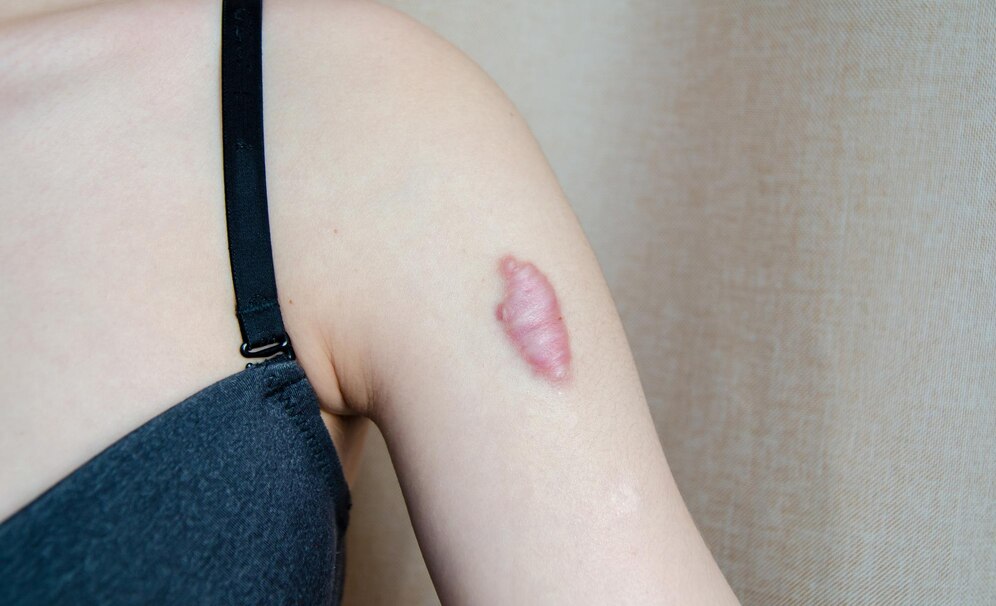 closeup-keloid-scar-shoulder-young-woman-rough-scar-tumorlike-growth-coarse-fibrous-connective-tissue-skin-treatment-laser_334328-653 Closeup keloid scar