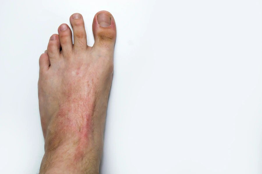 ezgif-1-e96f90115e scar in feet healed
