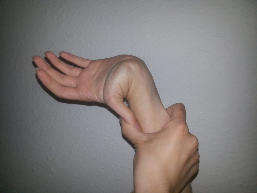 a picture of a thumb reaching the forearm showing hypermobility on fingers